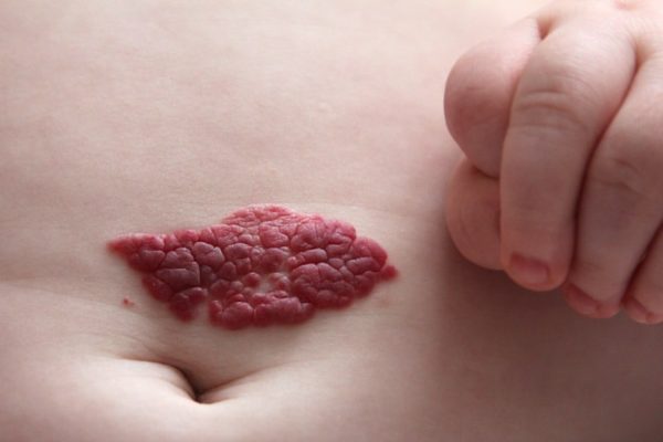 Emangioma Infantile: Cos’è e quali controlli effettuare